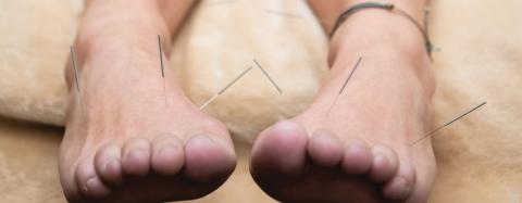 Feet with acupuncture needles