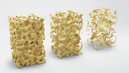 three examples of bone density